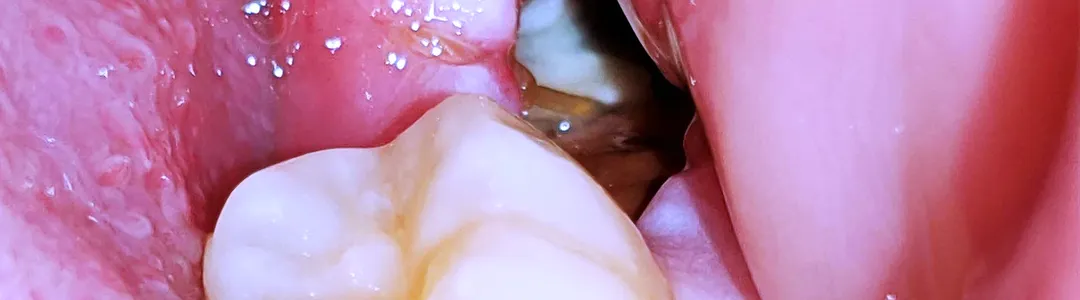 Dry Socket