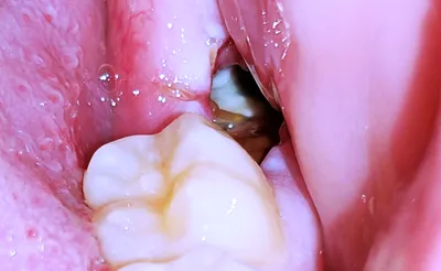 Dry Socket