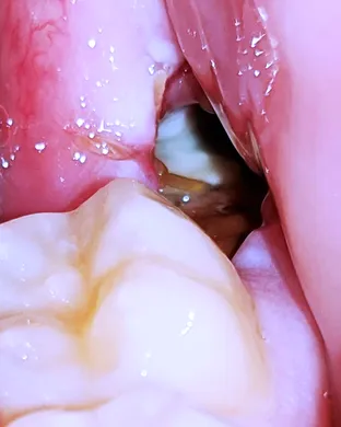 Dry Socket & Violencia